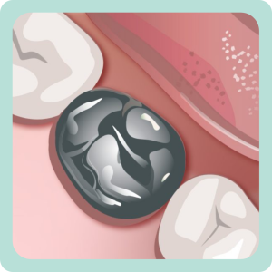 The Hall Technique for carious primary molars